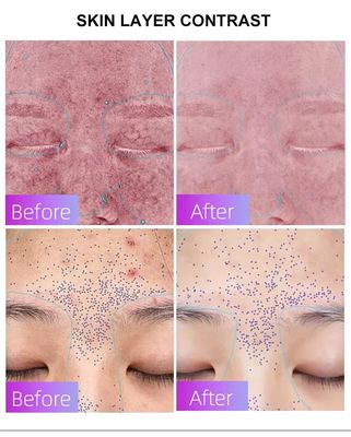 satın al Blue Light Acne Treatment Mask with Intelligent Timer – Manufacturer Direct Supply, Appearance Patent Included çevrimiçi üretim
